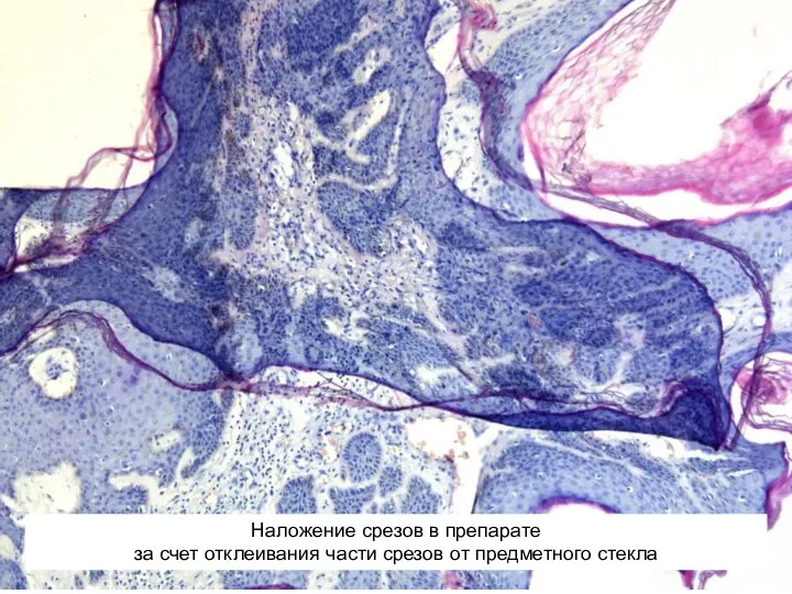 Наложение срезов в препарате за счет отклеивания части срезов от предметного стекла