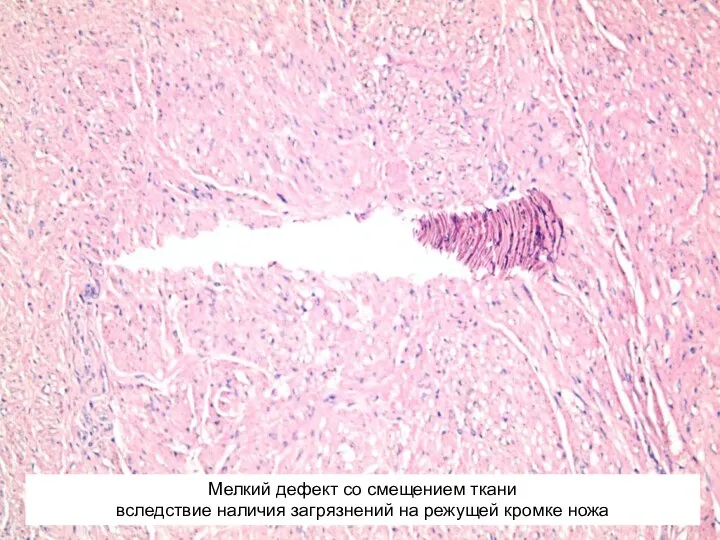 Мелкий дефект со смещением ткани вследствие наличия загрязнений на режущей кромке ножа