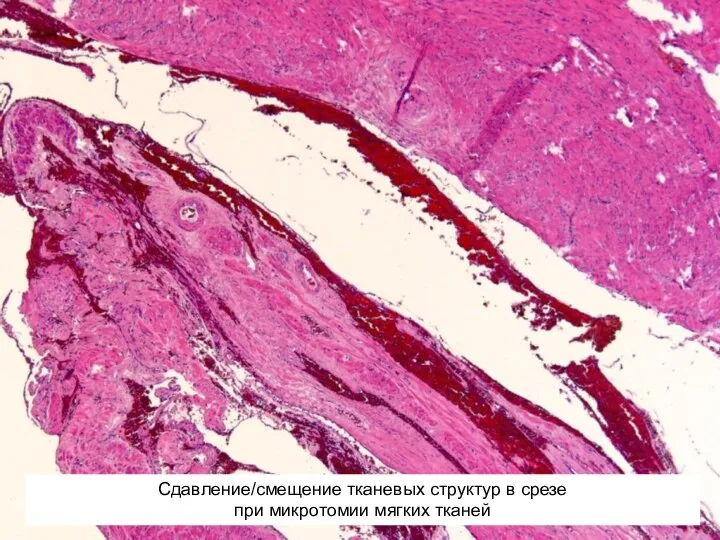 Сдавление/смещение тканевых структур в срезе при микротомии мягких тканей