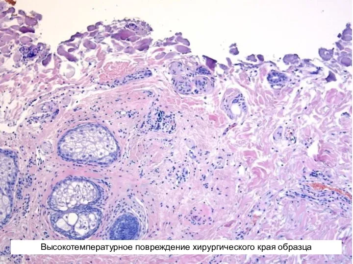 Высокотемпературное повреждение хирургического края образца