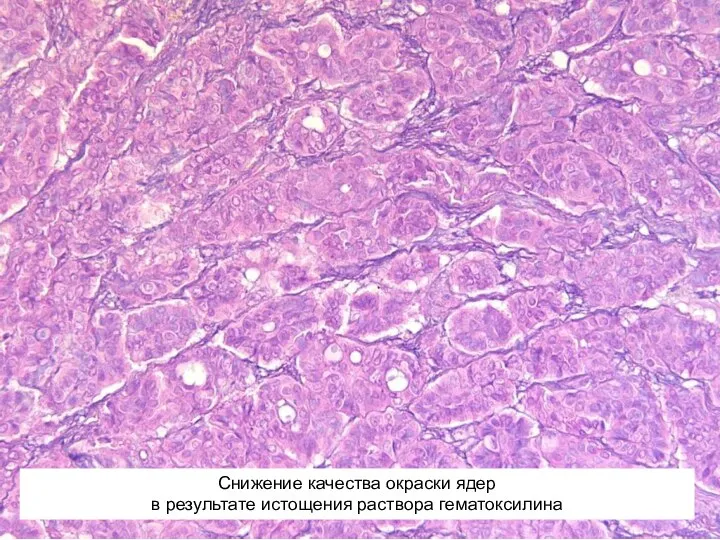 Снижение качества окраски ядер в результате истощения раствора гематоксилина