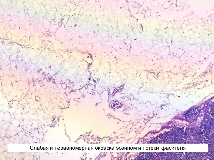 Слабая и неравномерная окраска эозином и потеки красителя