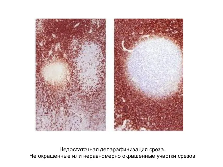 Недостаточная депарафинизация среза. Не окрашенные или неравномерно окрашенные участки срезов