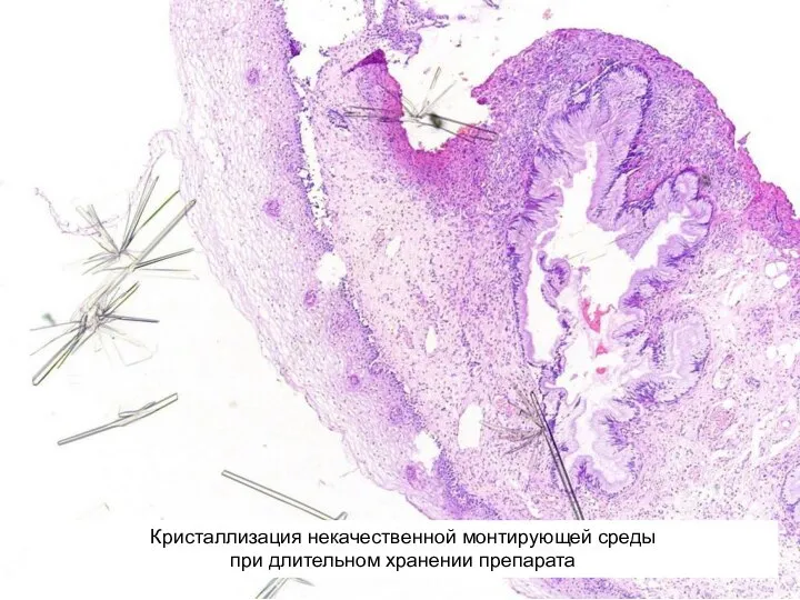 Кристаллизация некачественной монтирующей среды при длительном хранении препарата Кристаллизация некачественной монтирующей среды при длительном хранении препарата