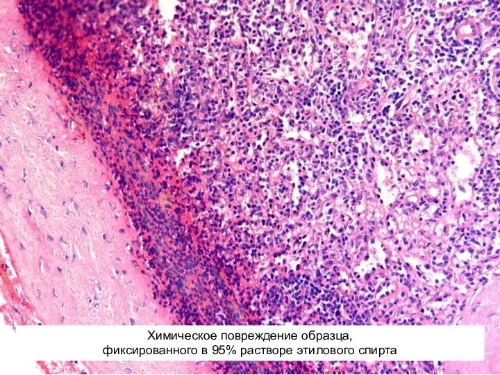 Химическое повреждение образца, фиксированного в 95% растворе этилового спирта