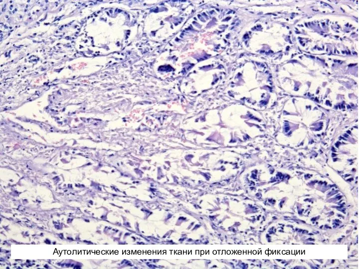 Аутолитические изменения ткани при отложенной фиксации