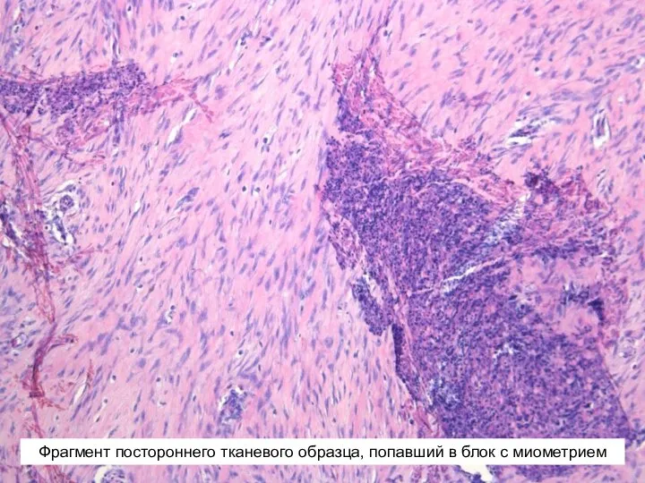 Фрагмент постороннего тканевого образца, попавший в блок с миометрием