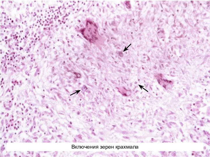 Включения зерен крахмала