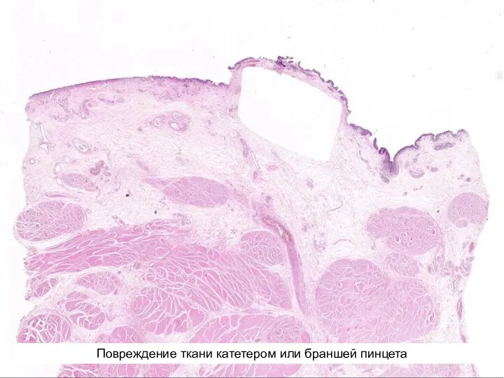 Повреждение ткани катетером или браншей пинцета