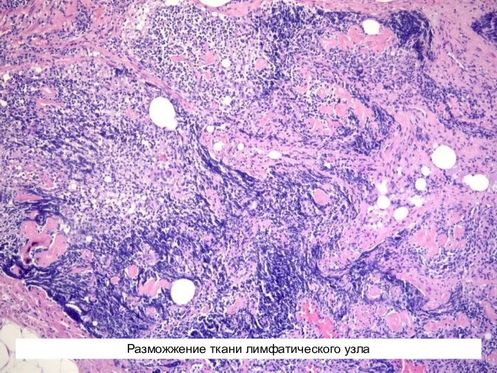 Разможжение ткани лимфатического узла