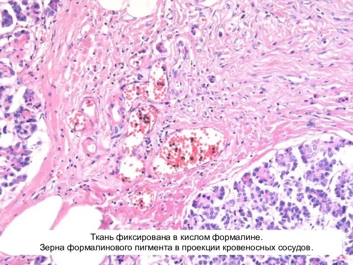 Ткань фиксирована в кислом формалине. Зерна формалинового пигмента в проекции кровеносных сосудов.