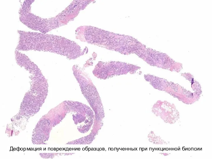 Деформация и повреждение образцов, полученных при пункционной биопсии