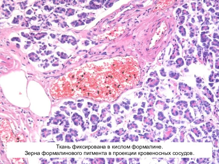 Ткань фиксирована в кислом формалине. Зерна формалинового пигмента в проекции кровеносных сосудов.