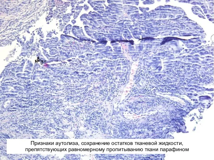 Признаки аутолиза, сохранение остатков тканевой жидкости, препятствующих равномерному пропитыванию ткани парафином