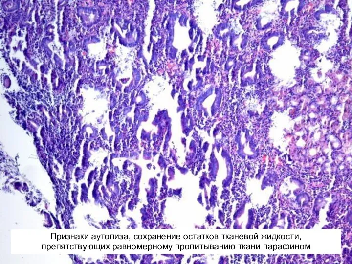 Признаки аутолиза, сохранение остатков тканевой жидкости, препятствующих равномерному пропитыванию ткани парафином