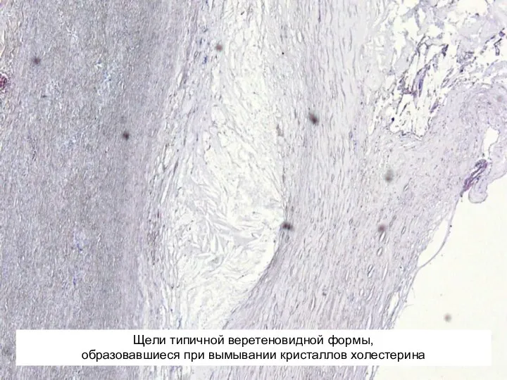 Щели типичной веретеновидной формы, образовавшиеся при вымывании кристаллов холестерина