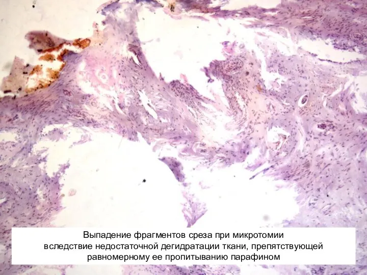 Выпадение фрагментов среза при микротомии вследствие недостаточной дегидратации ткани, препятствующей равномерному ее пропитыванию парафином