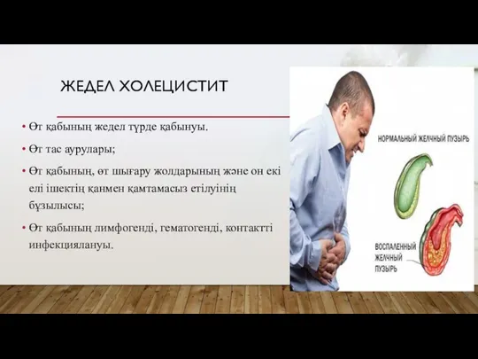 ЖЕДЕЛ ХОЛЕЦИСТИТ Өт қабының жедел түрде қабынуы. Өт тас аурулары; Өт қабының,