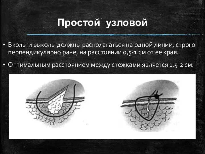 Простой узловой Вколы и выколы должны располагаться на одной линии, строго перпендикулярно