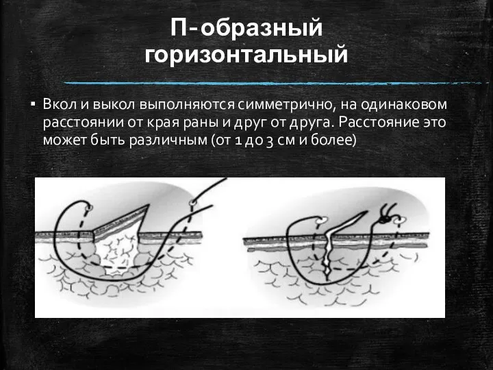 П-образный горизонтальный Вкол и выкол выполняются симметрично, на одинаковом расстоянии от края