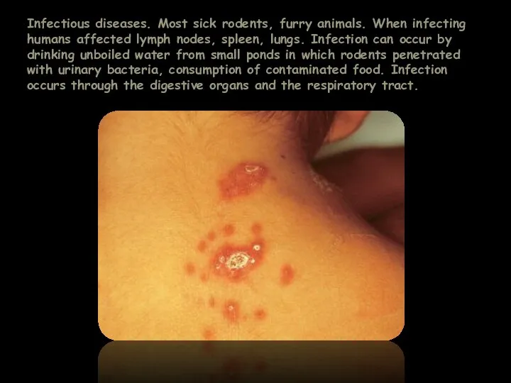 Infectious diseases. Most sick rodents, furry animals. When infecting humans affected lymph