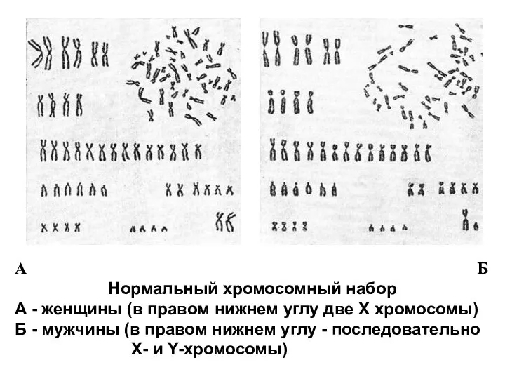 А Б Нормальный хромосомный набор А - женщины (в правом нижнем углу