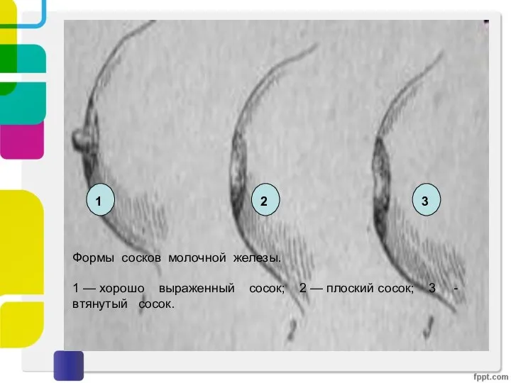 Формы сосков молочной железы. 1 — хорошо выраженный сосок; 2 — плоский