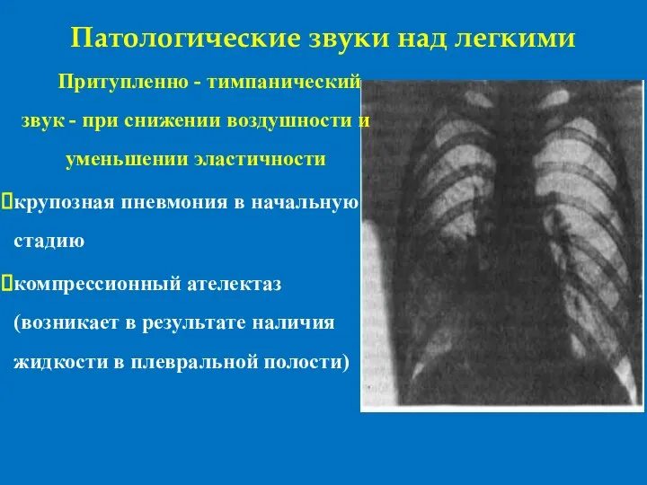 Патологические звуки над легкими Притупленно - тимпанический звук - при снижении воздушности