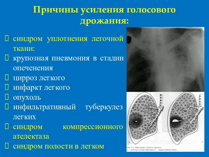 Причины усиления голосового дрожания: синдром уплотнения легочной ткани: крупозная пневмония в стадии