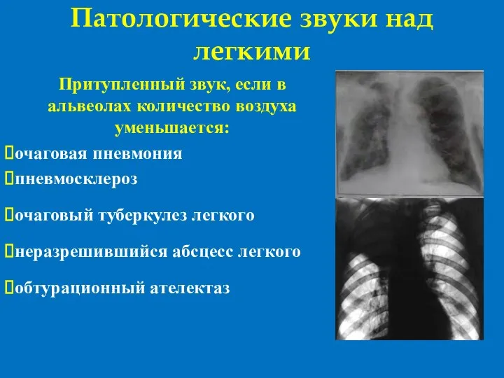 Патологические звуки над легкими Притупленный звук, если в альвеолах количество воздуха уменьшается: