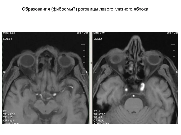 Образования (фибромы?) роговицы левого глазного яблока