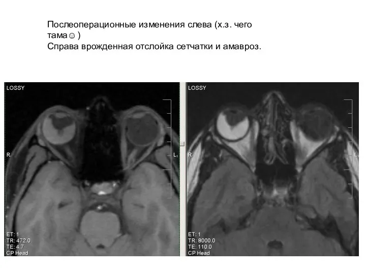 Послеоперационные изменения слева (х.з. чего тама☺) Справа врожденная отслойка сетчатки и амавроз.