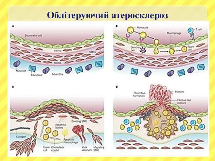 Облітеруючий атеросклероз