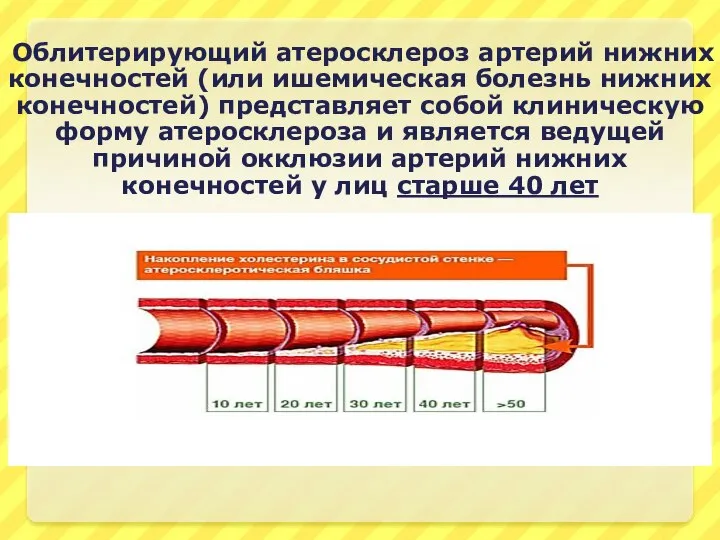 Облитерирующий атеросклероз артерий нижних конечностей (или ишемическая болезнь нижних конечностей) представляет собой