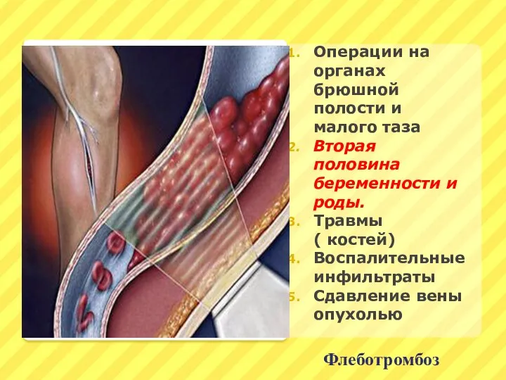 Флеботромбоз Операции на органах брюшной полости и малого таза Вторая половина беременности