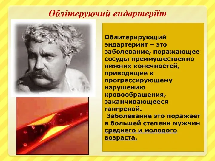 Облітеруючий ендартеріїт Облитерирующий эндартериит – это заболевание, поражающее сосуды преимущественно нижних конечностей,