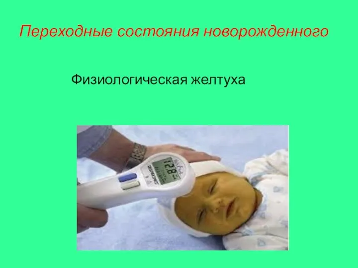 Переходные состояния новорожденного Физиологическая желтуха