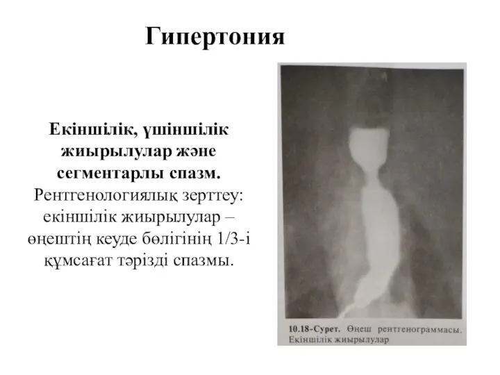 Гипертония Екіншілік, үшіншілік жиырылулар және сегментарлы спазм. Рентгенологиялық зерттеу: екіншілік жиырылулар –