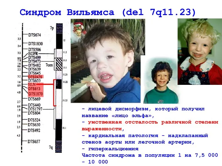 Синдром Вильямса (del 7q11.23) - лицевой дисморфизм, который получил название «лицо эльфа»,