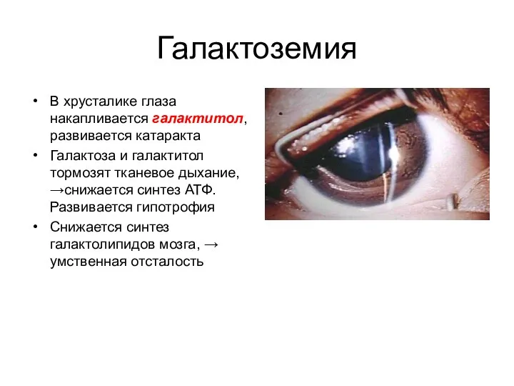 Галактоземия В хрусталике глаза накапливается галактитол, развивается катаракта Галактоза и галактитол тормозят