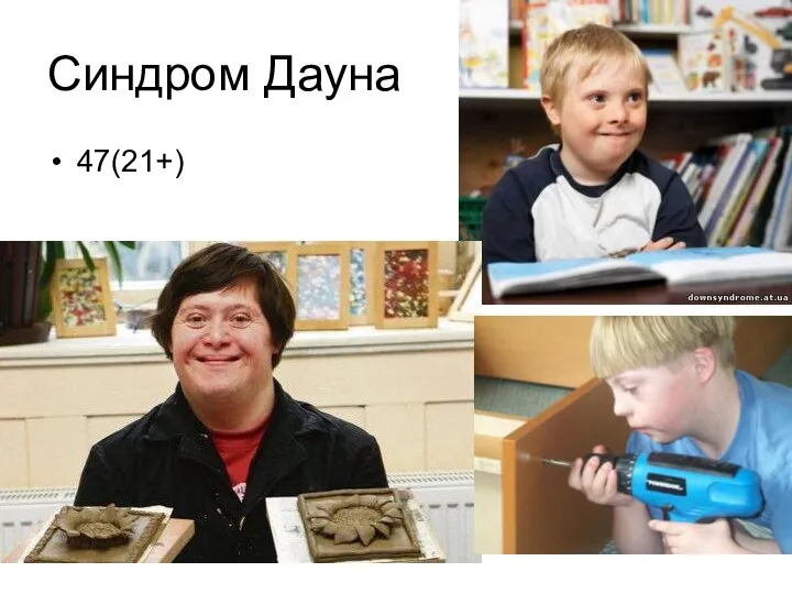 Синдром Дауна 47(21+)