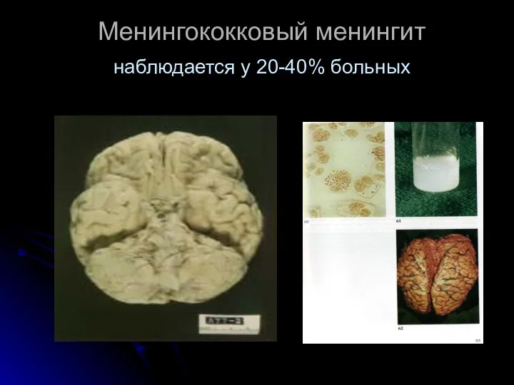 Менингококковый менингит наблюдается у 20-40% больных