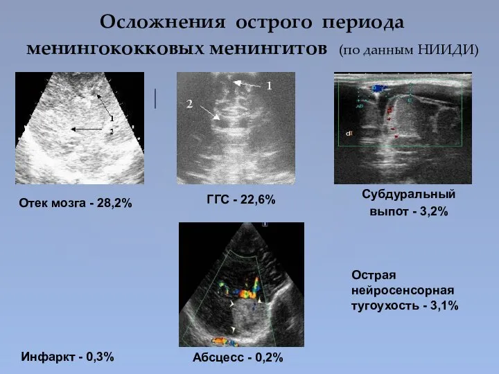 Осложнения острого периода менингококковых менингитов (по данным НИИДИ) Отек мозга - 28,2%