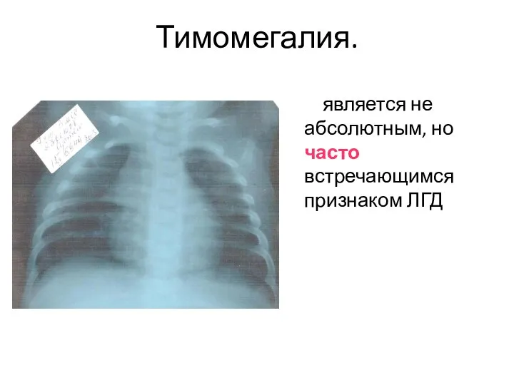 Тимомегалия. является не абсолютным, но часто встречающимся признаком ЛГД