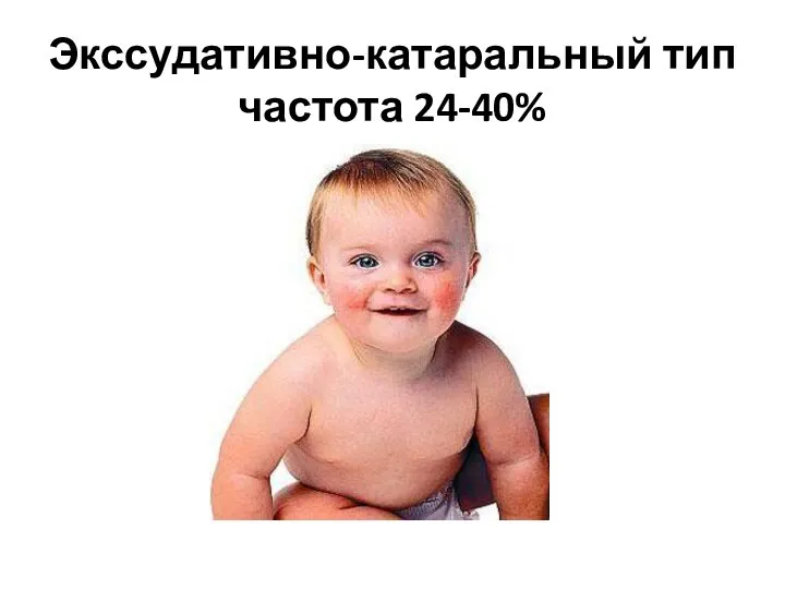 Экссудативно-катаральный тип частота 24-40%