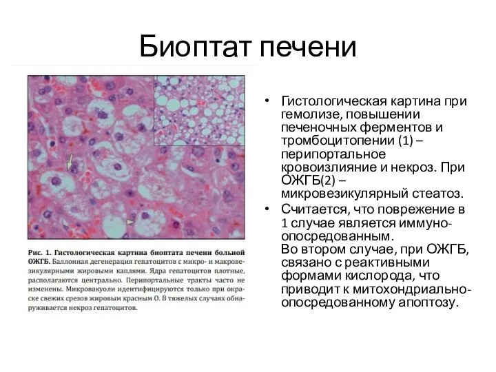 Биоптат печени Гистологическая картина при гемолизе, повышении печеночных ферментов и тромбоцитопении (1)