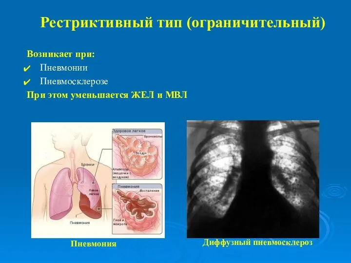 Рестриктивный тип (ограничительный) Возникает при: Пневмонии Пневмосклерозе При этом уменьшается ЖЕЛ и МВЛ Диффузный пневмосклероз Пневмония