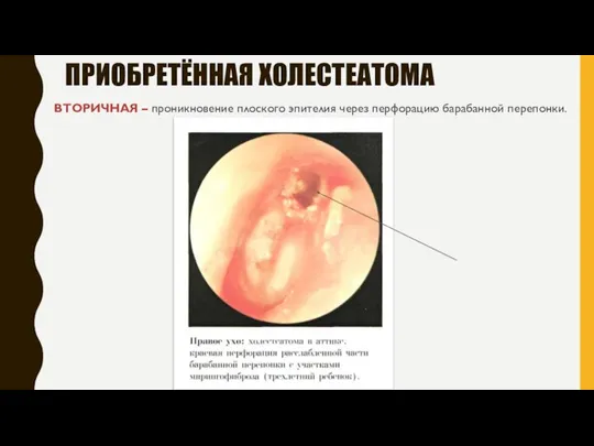 ВТОРИЧНАЯ – проникновение плоского эпителия через перфорацию барабанной перепонки. ПРИОБРЕТЁННАЯ ХОЛЕСТЕАТОМА