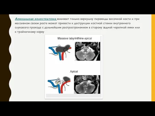 Апикальная холестеатома занимает только верхушку пирамиды височной кости и при массивном своем