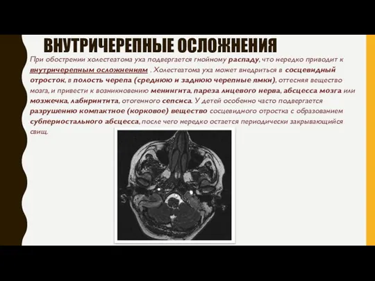 ВНУТРИЧЕРЕПНЫЕ ОСЛОЖНЕНИЯ При обострении холестеатома уха подвергается гнойному распаду, что нередко приводит